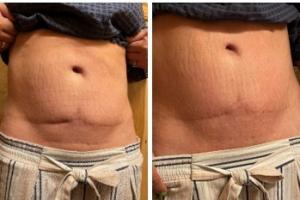 Before and after treatment showing significant results in reducing scar size.