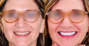 ore-and-after photo showing a woman’s smile before and after a dental makeover, with brighter and more uniform teeth in the final image.