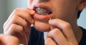 Close-up of a person threading dental floss beneath an orthodontic archwire.