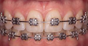 Close-up of fixed orthodontic braces showing brackets and archwires on upper and lower teeth.