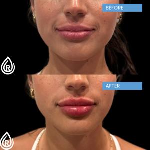 lip-filler-at-refresh-aesthetics-and-wellness