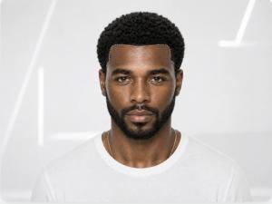 Afro hair transplant result: coily hair grown from grafts placed along a rebuilt hairline