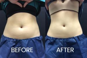 CoolSculpting Fat Reduction at SkinLab
