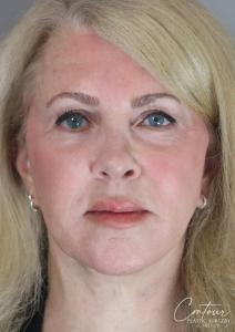 After Facelift with Facial Fat Grafting