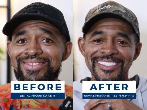 Man smiling before and after getting full mouth dental implants
