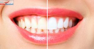 Teeth Whitening Brisbane
