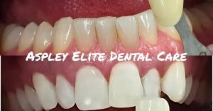 Teeth Whitening Results from Aspley Elite Dental Care