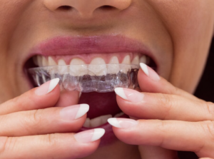 los angeles invisalign