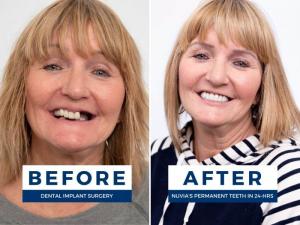 Woman smiling before and after getting full mouth dental implants