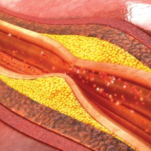 Illustration of a clogged artery