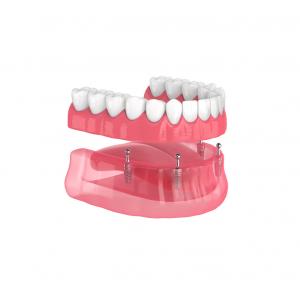 Full-Arch Tooth Replacement