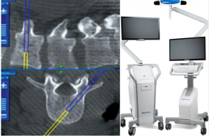 Medtronic StealthStation S8 neuronavigation system used for image-guided neurosurgery and precision planning at Dr. Rao’s Hospital, Guntur.