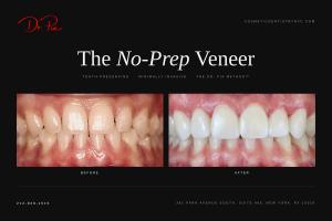 Before and after photos of no-prep porcelain veneers by Dr. Pia Lieb, Cosmetic Dentistry NYC