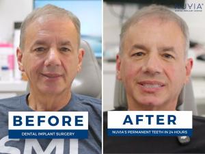 Cortney Reardanz Fiance Phil Before and After Getting Full Mouth Dental Implants at Nuvia