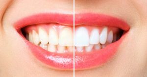 affordable Brisbane teeth whitening