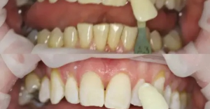 Before-after Teeth Whitening Results