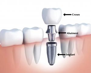 Parkview Dental Associates - Dental Implants