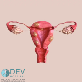 Medical illustration of the uterus showing uterine fibroids