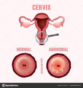 Cancer cervicouterino
