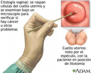 Citología vaginal para cancer cervicouterino