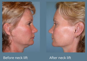 Hove Center for Facial Plastic Surgery is highly respected for beautiful, natural-looking neck lift results.