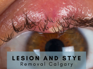 Lesion and Stye Removal Calgary
