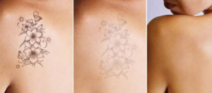 The tattoo ink will gradually fade away without any skin abrasion