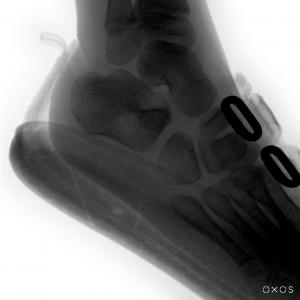Image of pediatric foot with shoe on. Shows laces and sole of foot as well as bones.