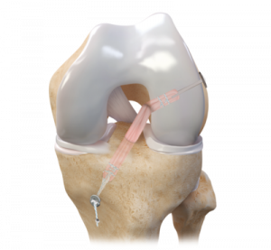 ACL/PCL Reconstruction using Arthrex's Flipcutter