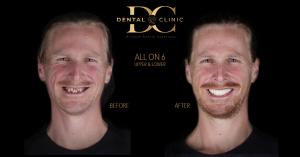 All on 6 Implants Before & After at Dental Clinic Cancun