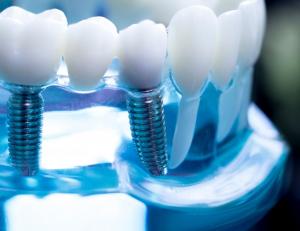 dental imapltns