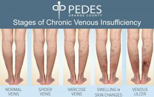 Stages Chronic Venous Insufficiency - Pedes-Orange-County
