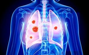 Non Small-Cell Lung Cancer Market