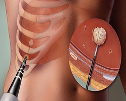 Tumor Ablation Market Analysis Report