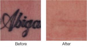 A breakthrough in tattoo and cosmetic tattoo removal