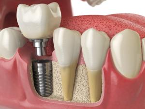 Dental bone graft substitute