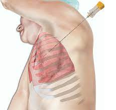 Lung Biopsy Devices