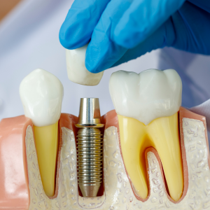 Asia pacific dental implants markets