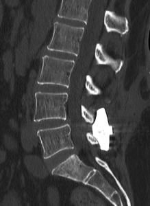 CT Scan Image, Inspan, Interspinous Process Stabilization Device, Lumbar Spine