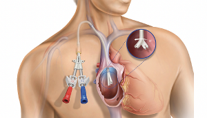 Hemodialysis Catheter Market