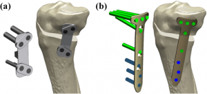 Osteotomy Plates Market