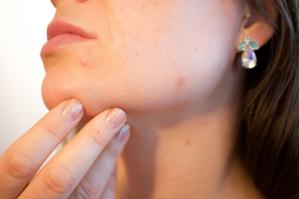 What does skin purging look like. woman touches the acne and pimple on her purging face