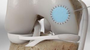 Cartilage Repair Market