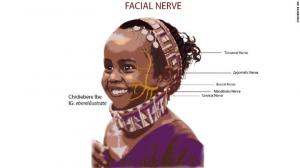 Medical image of a little brown girl