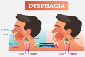 Dysphagia Management Market