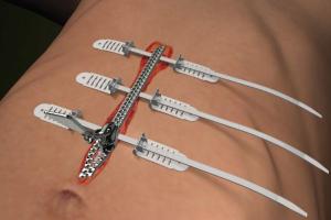 Wound Closure Market