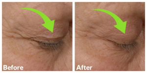 before and after eye lids