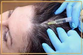 Alopecia Treatment Market
