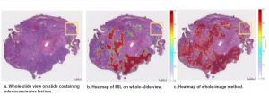 aetherAI’s method demonstrates higher classification performance than multiple-instance learning.
