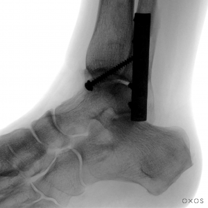 Ankle capture with Micro C. Low radiation. Hardware.